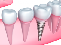 implanturile dentare